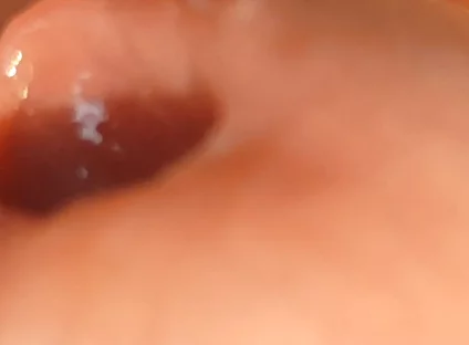 The Great Transformation of Phimosis Elastica.