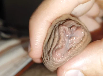 Silent Purge of Straight Scrotal Fluid.