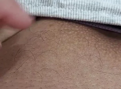 The Hair on My Penis - Led Hair Removal