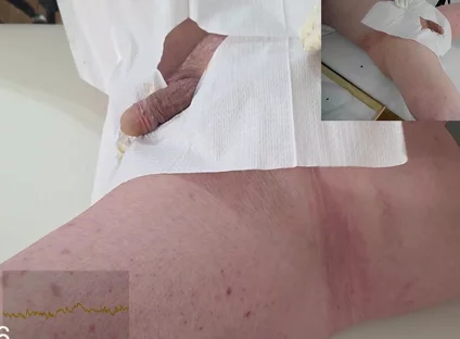 16 French Foley Insertion
