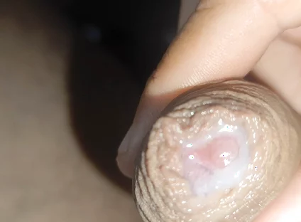 I Have the Largest Ejaculating Phimosis in the World!!