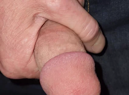 Gaping Urethra - Marker and Pinky Insertion