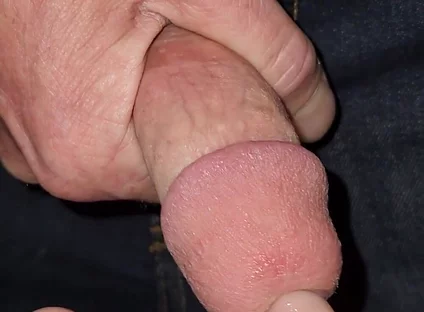 Gaping Urethra - Marker and Pinky Insertion