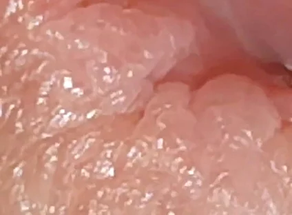 Enlargement of the Deep Urethral Hole!!