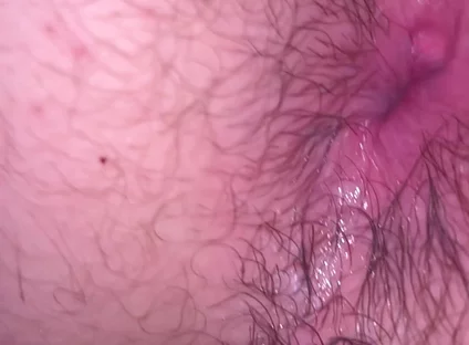 Bruised Asshole
