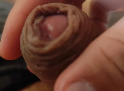 Great Phimosis Getting in the Way of the Boy's Orgasm