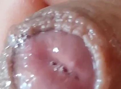 Deep Split in the Glans Produces Bubbling Liquid