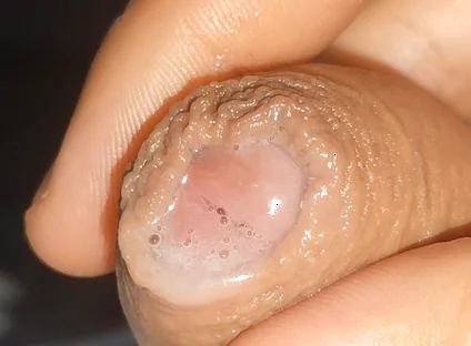 Curious Close-up of Pre-cum in Flaccid Phimosis.