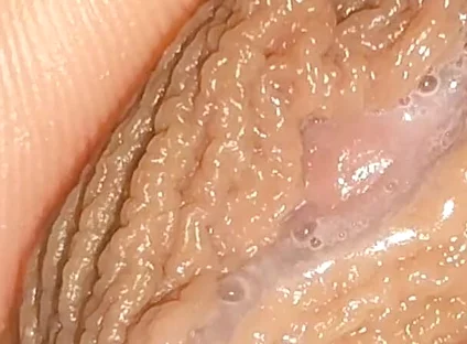 Curious Close-up of Pre-cum in Flaccid Phimosis.