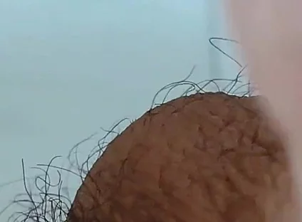 Extreme Open Hole Leaves the Glans Exposed.