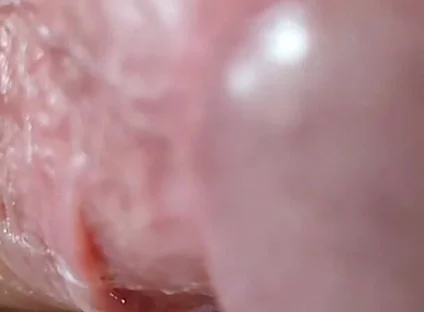 Opening the Scar of the Rough Frenulum!