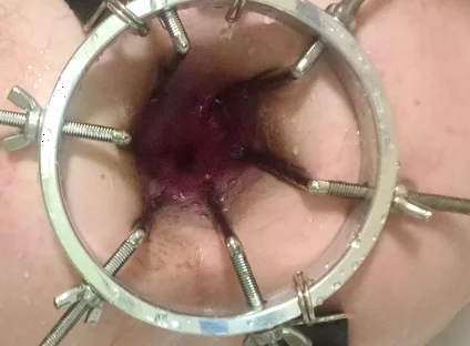 Enema, Anal Shower. Close-up View Through Anal Mirror. Anal with Water. Filling Anal with Water