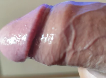 Strange Lumpy Cock with a Gigantic Head.