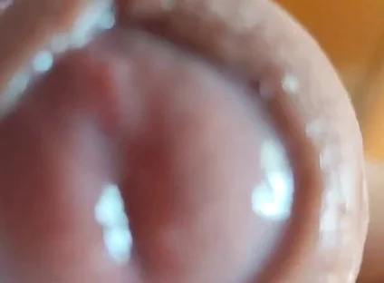 The Glans Appears Crowning Inside the Phimosis.