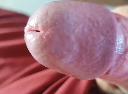 The Blossoming of Extensive Elastic Phimosis.