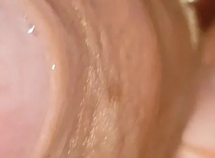 Large Cheese Accumulated in Close up of Glans