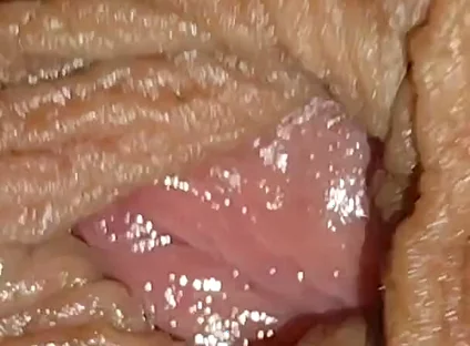 Boy with Large Anal Phimosis Excited!