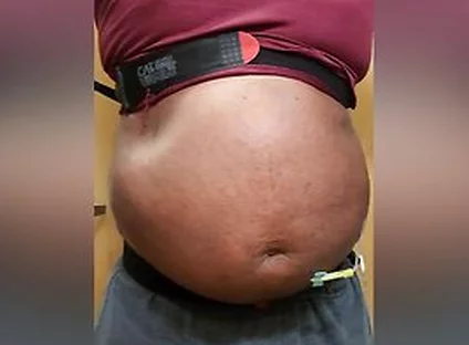 N2o Belly Inflation