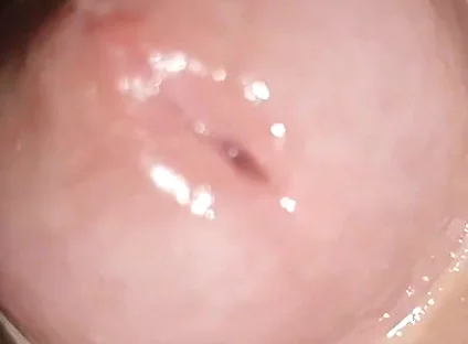 Maximum Dilation of Phimosis Cumming.