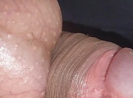 Amazing Upright Rough Venous Frenulum.
