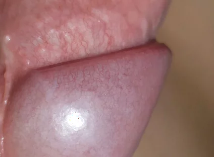 Amazing Upright Rough Venous Frenulum