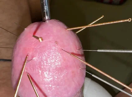 Acupuncture - Orgasm!