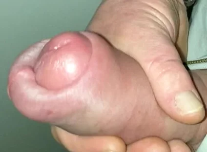 Huge Cock Pumped Foreskin Jerk off