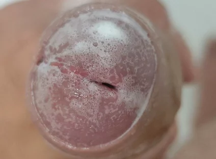 Extreme Burning Sensation Makes the Glans Foam with Arousal.