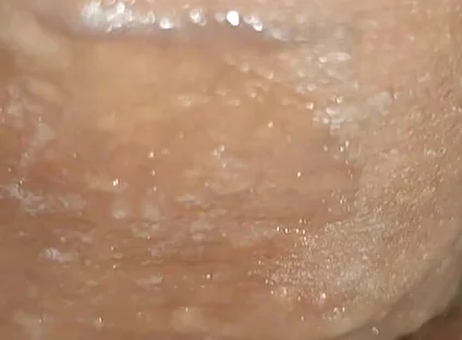 Scrotal Phimosis Results in an Extremely Hot Orgasm.