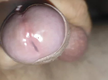 Scrotal Phimosis Results in an Extremely Hot Orgasm.