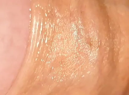 Difficult Fluid Control Due to Straight Phimosis.