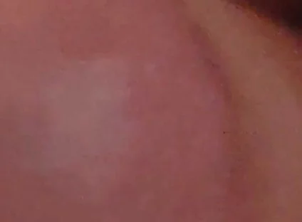 Immense Phimosis Being Extracted Cum and Précum.