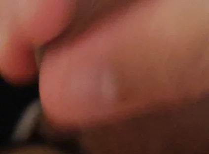 Immense Phimosis Being Extracted Cum and Précum.